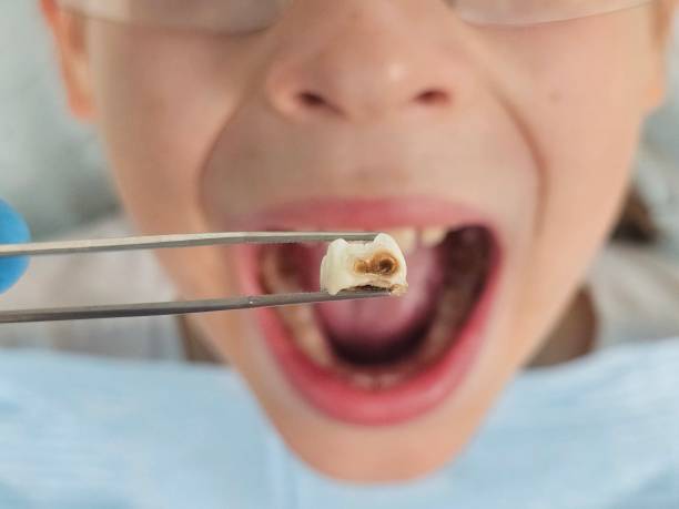 Best Emergency Tooth Extraction  in Dawson, MN